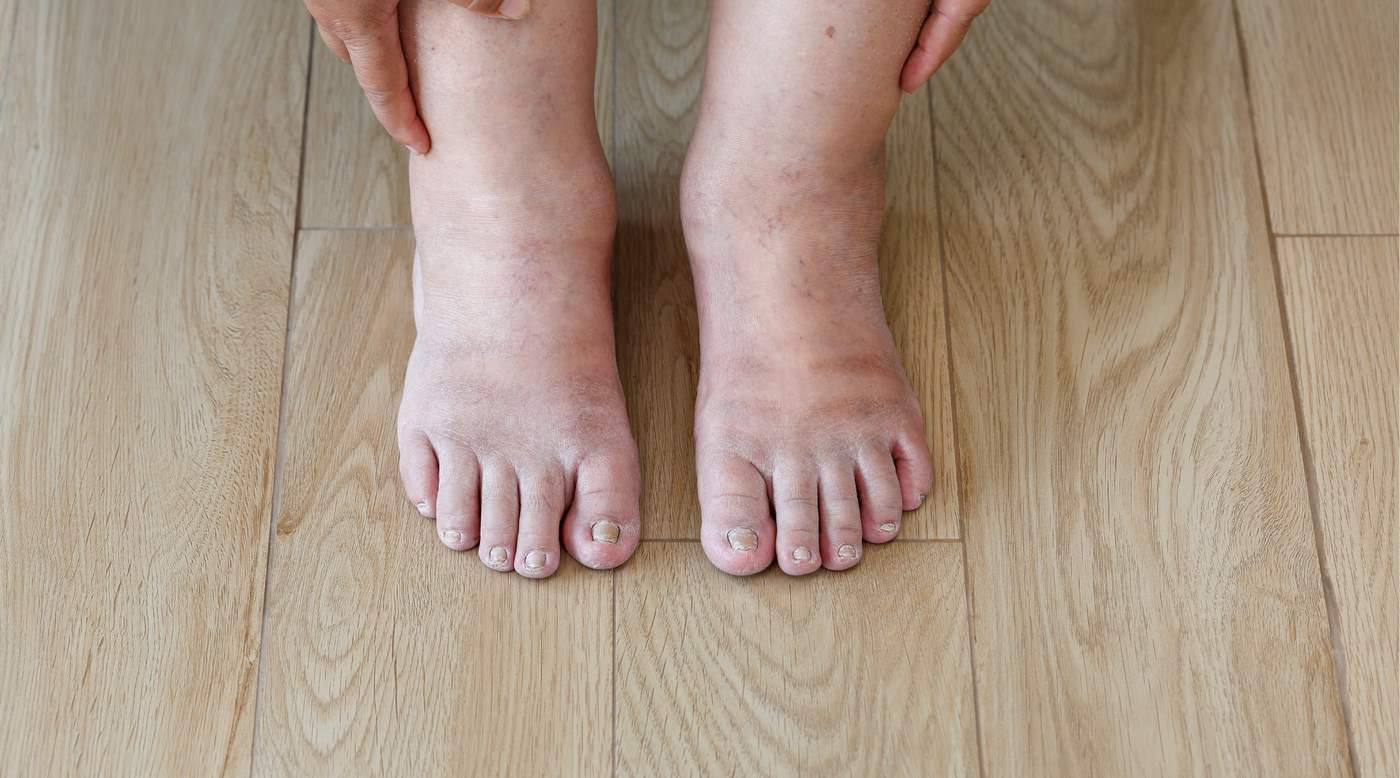 Purple Feet Diabetes: Exploring Its Causes and Symptoms Circufiber